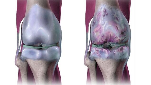 Nyje e shëndetshme e gjurit dhe e prekur nga artroza