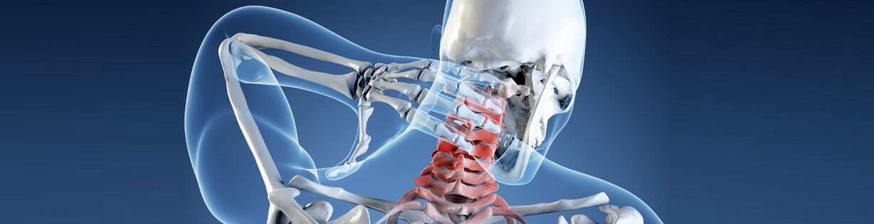 Osteokondroza e shpinës së qafës së mitrës njerëzore