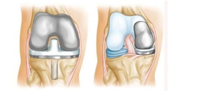 artroplastika për artrozën e kyçit të gjurit