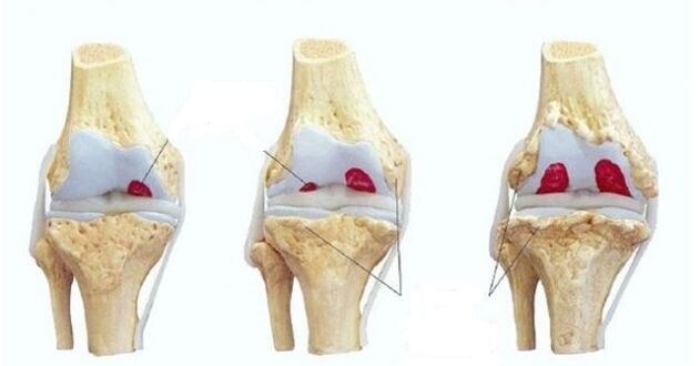 fazat e artrozës së kyçit të gjurit