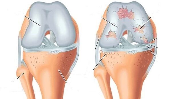 nyje e shëndetshme dhe artrozë e përbashkët e gjurit