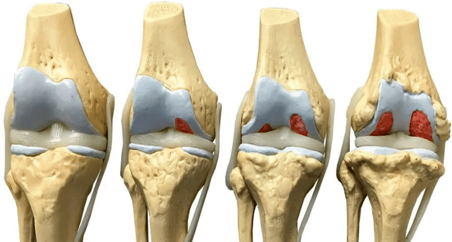 dëmtimi i nyjes së gjurit në faza të ndryshme të zhvillimit të artrozës