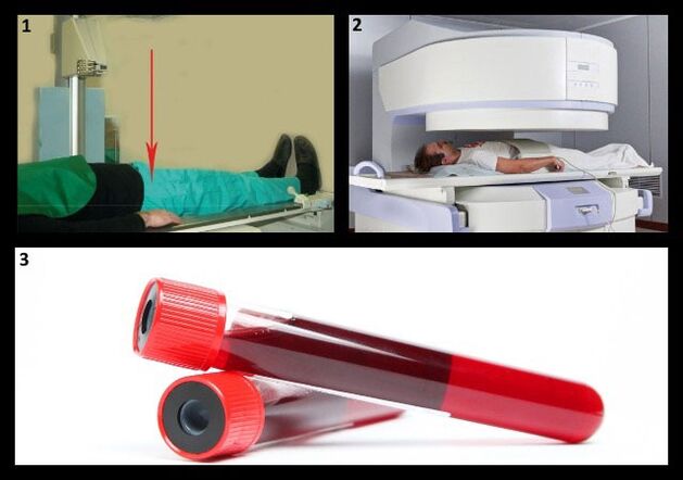 Metodat për diagnostikimin e koksartrozës - Rrezet X dhe MRI të kyçit të hip, testi i gjakut