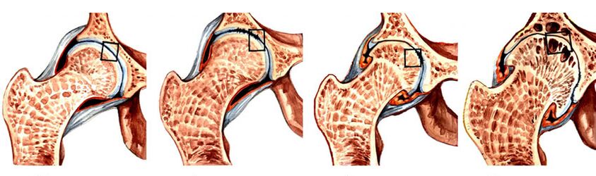 Shkalla e zhvillimit të artrozës së nyjes së hip