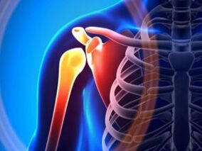 Nyje e përflakur e shpatullave për shkak të artrozës - një sëmundje kronike e sistemit musculoskeletal