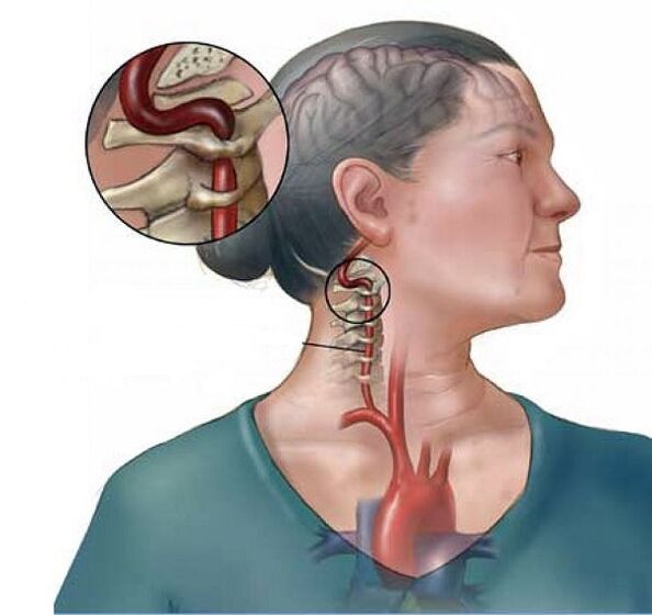 sindromi i arteries vertebrale me osteokondrozë cervikale